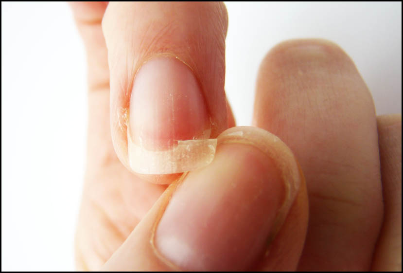 Ломкость ногтей как выглядит и как проявляется